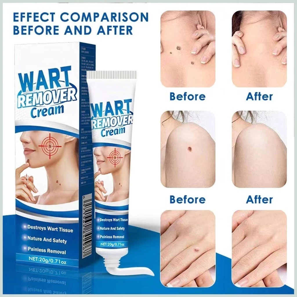 Kem Bôi Mụn Thịt Dư HBESTY WART REMOVER CREAM - Kem HBESTY Rụng Cồi Mụn, Rụng Mụn Thịt Dư, Không Đau Ngứa